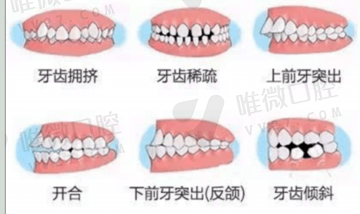 牙周翻瓣术后发白正常吗（牙周翻瓣花了3万多）(图1)